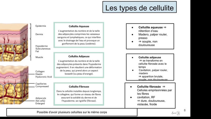 Les types de cellulite